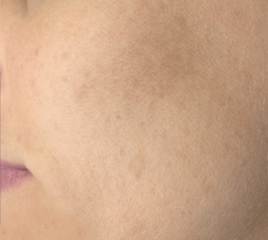 pigmentation removal after