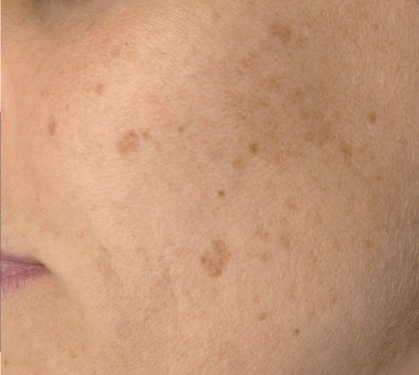 pigmentation removal before